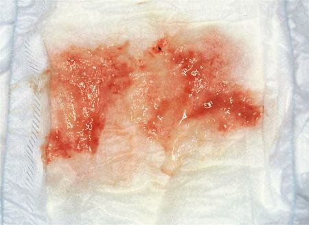 赤ちゃんのうんちが黒 赤 白は病気のサイン 症例写真で見る病気の見分け方 Baby Mo ベビモ