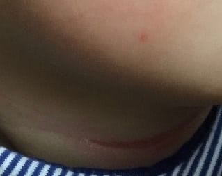 乳児の首の湿疹が臭い時の対策は 薬は必要 体験談紹介 医師監修 Baby Mo ベビモ