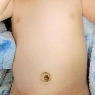 臍ヘルニア 写真